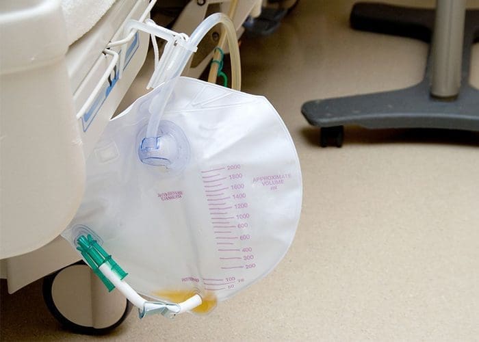 Urinary Catheter, a Foley Bag